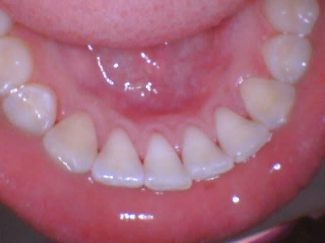 before_orthodontics before orthodontics