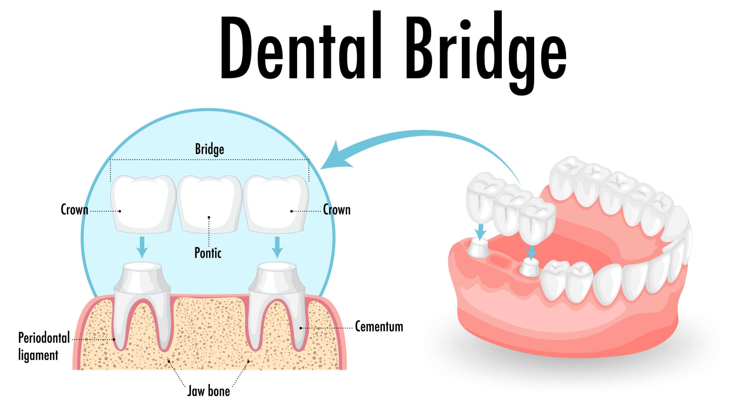 dental bridge