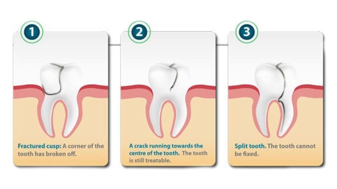 CHIPPED TOOTH