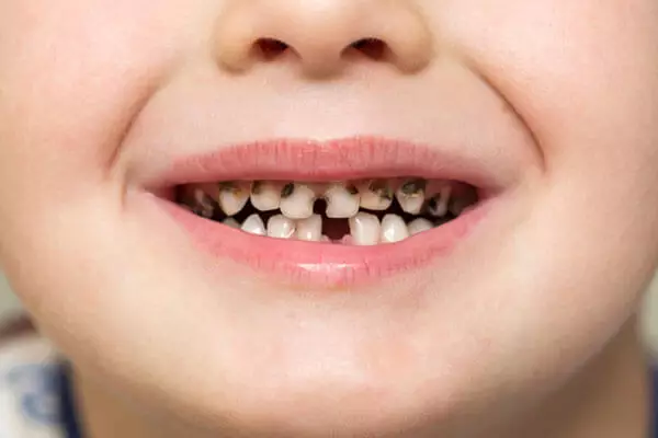 Black Teeth 