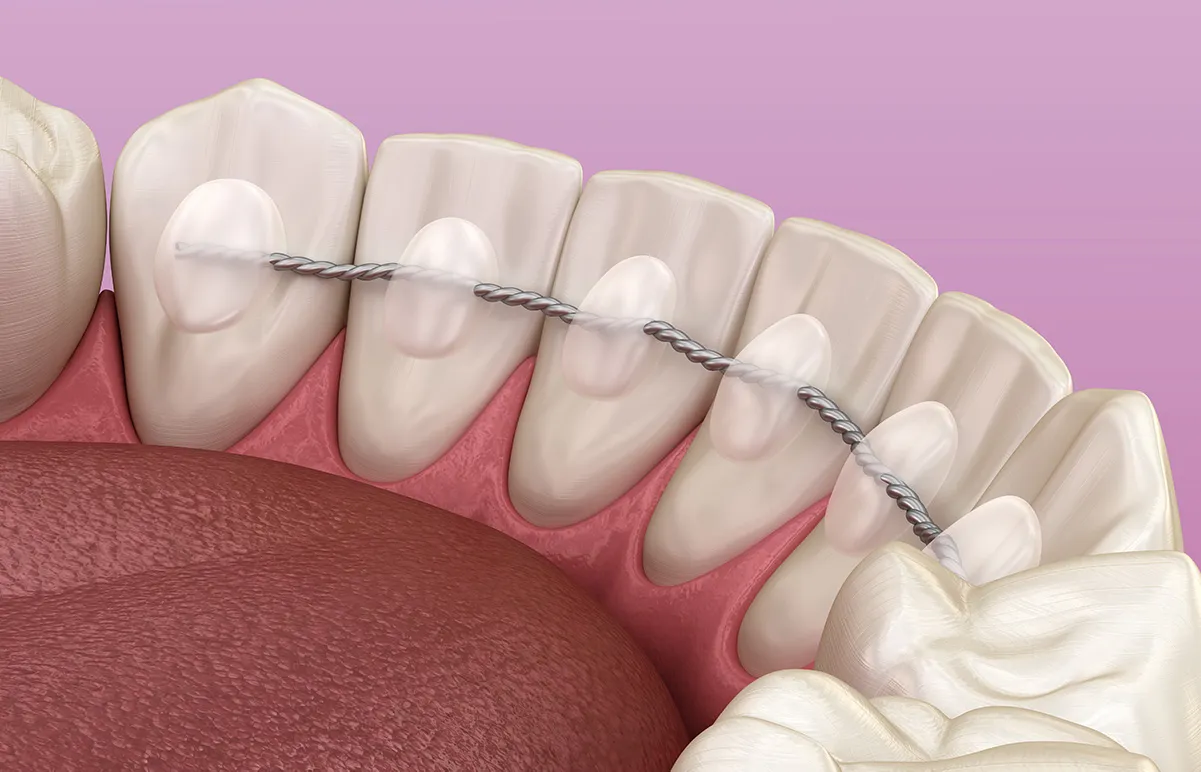 Conventional Orthodontics