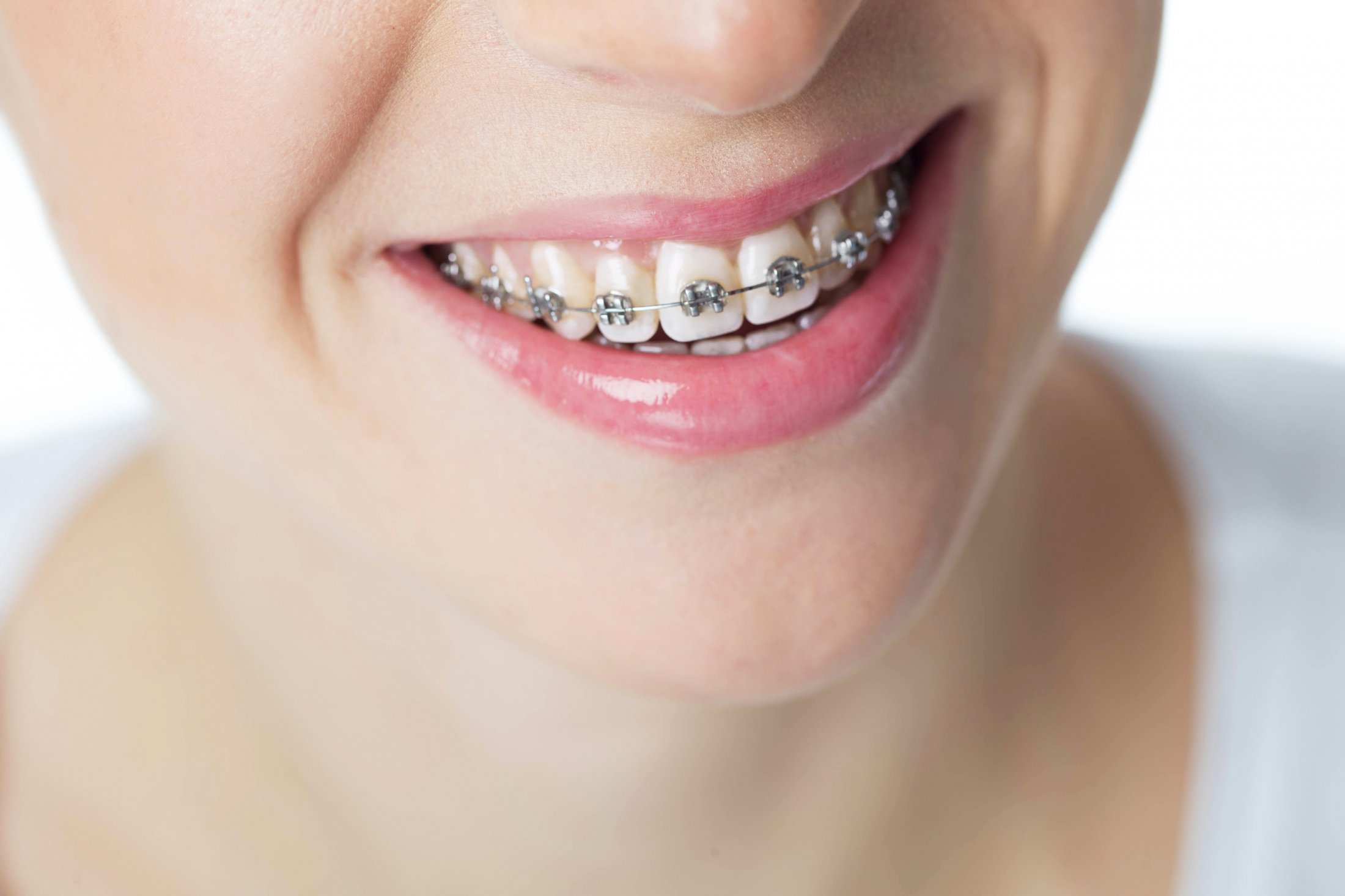 Conventional Orthodontics