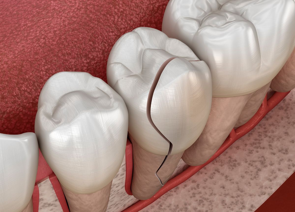 Cracked tooth