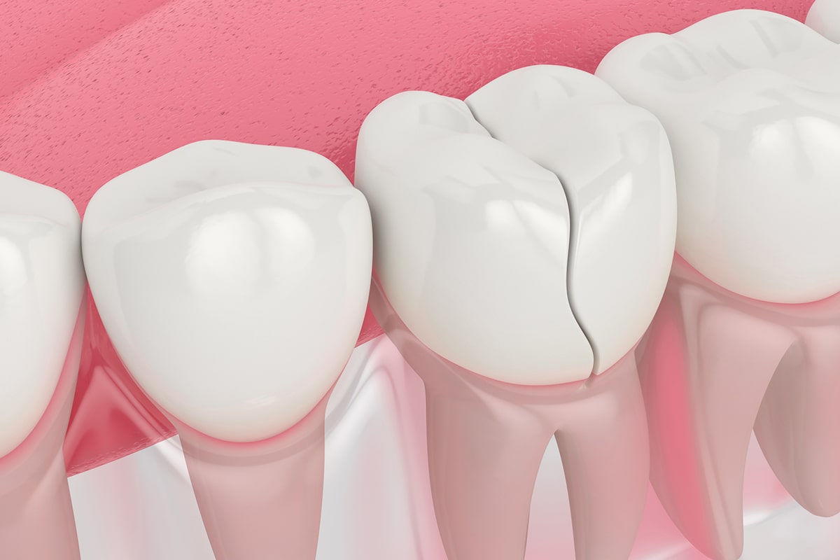 Cracked tooth