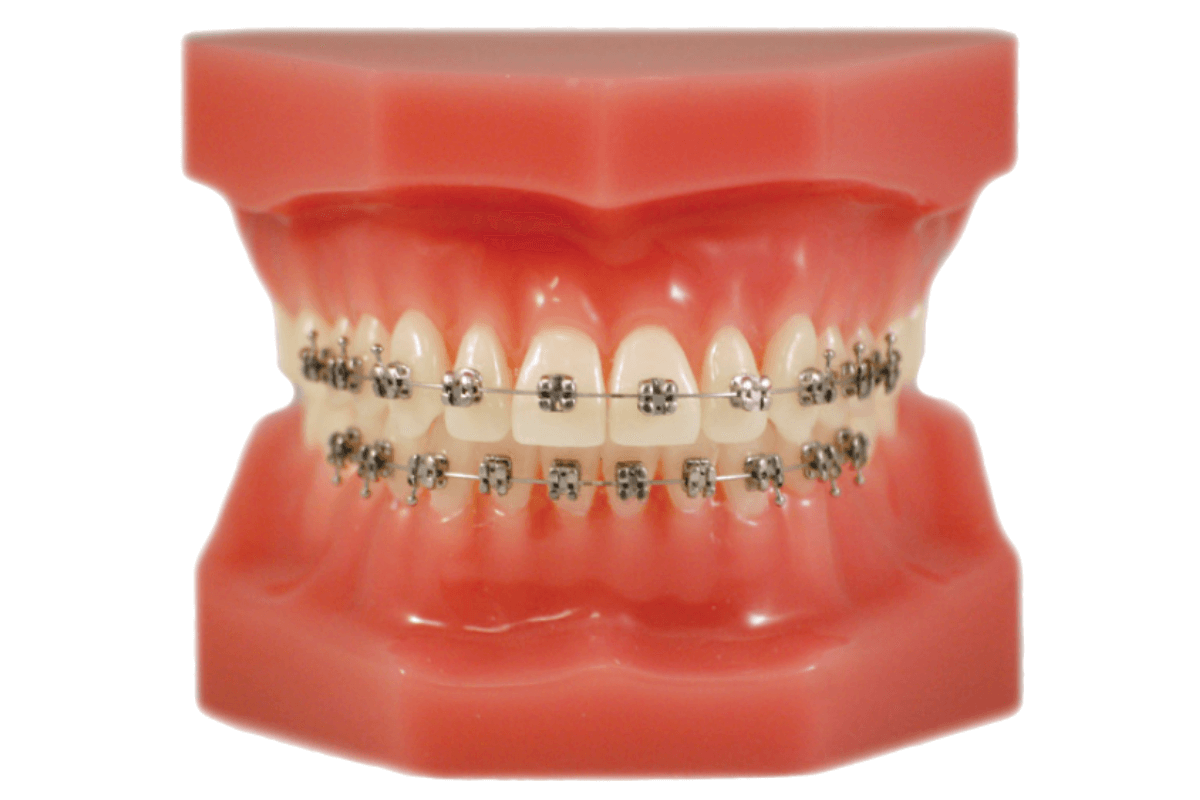 Fake Braces