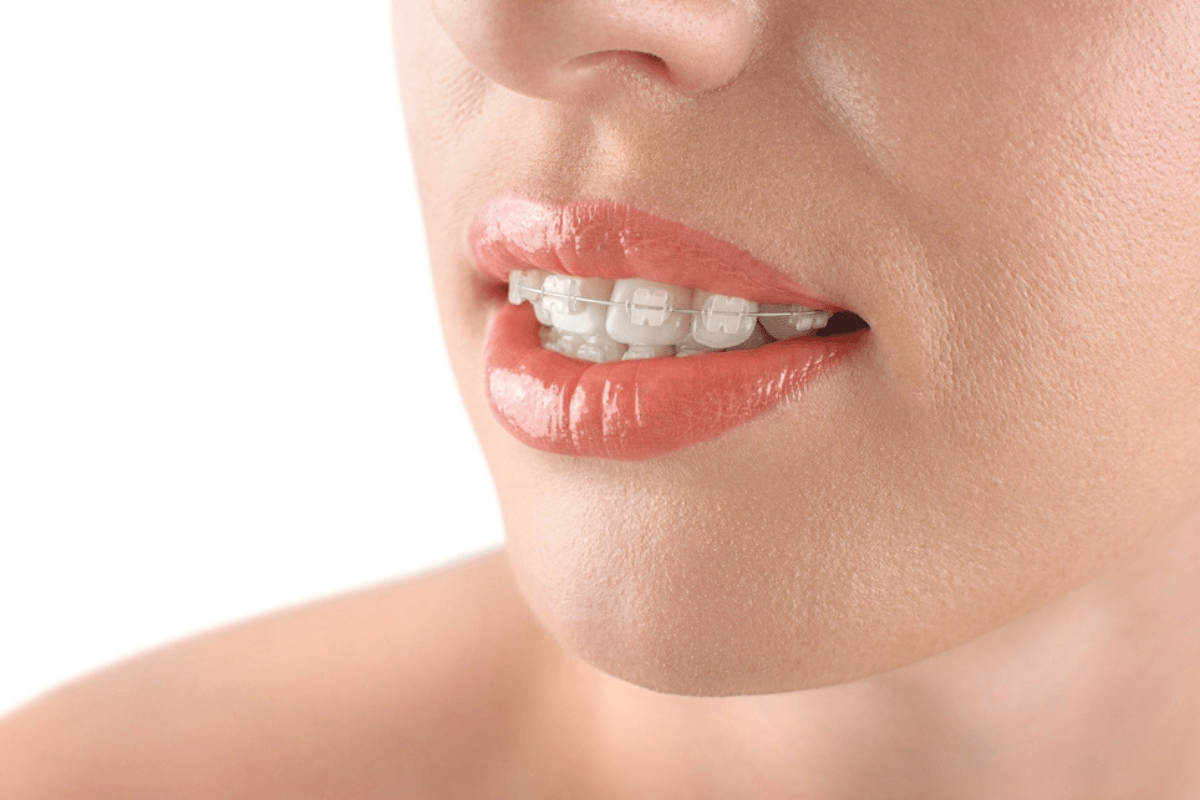 Clear Braces