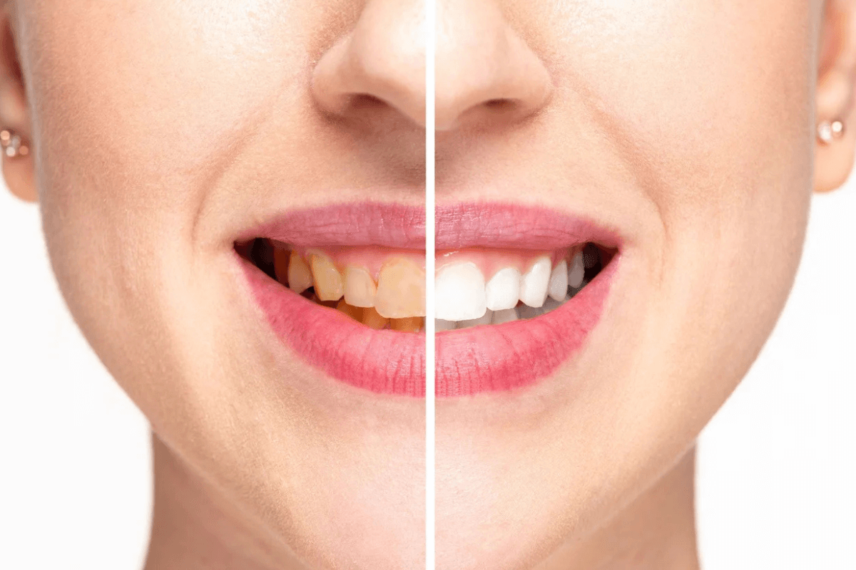 Stained Teeth