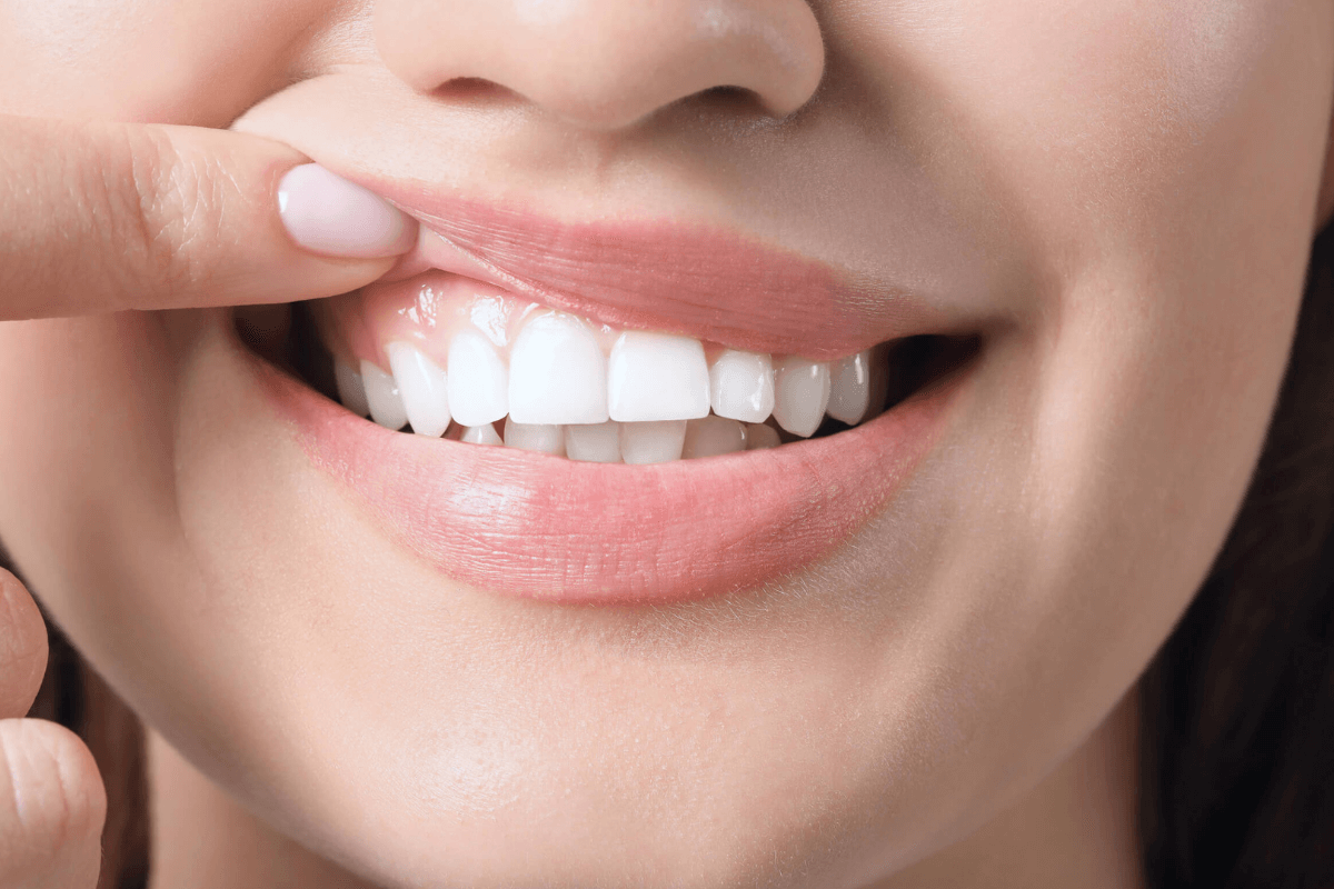 Gum Line Cavities